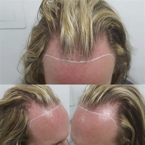 bbl trans|BBL + Lipo 360 (MtF Body Feminization) 11 months .